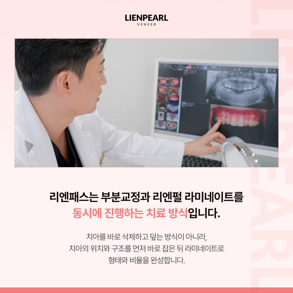 앞니 라미네이트 비용 고민된다면? 함께 확인해야 할 기준 관련 이미지 3