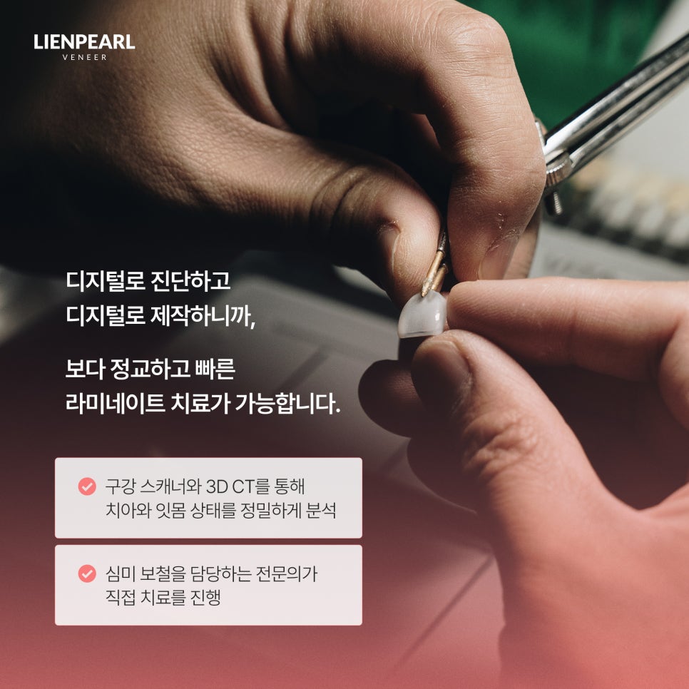 라미네이트 후기, 시술 방법과 결과! 관련 이미지 6