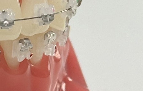연희임플란트 디지털 네비게이션과 3D 기술로 안전하고 정밀하게 관련 이미지 11