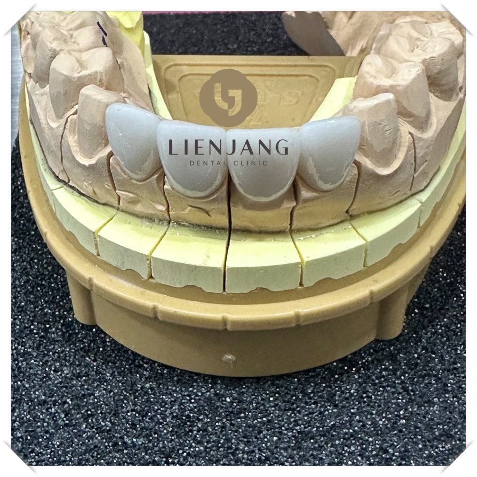 용답동임플란트 뼈 이식까지 고려한다면 관련 이미지 3