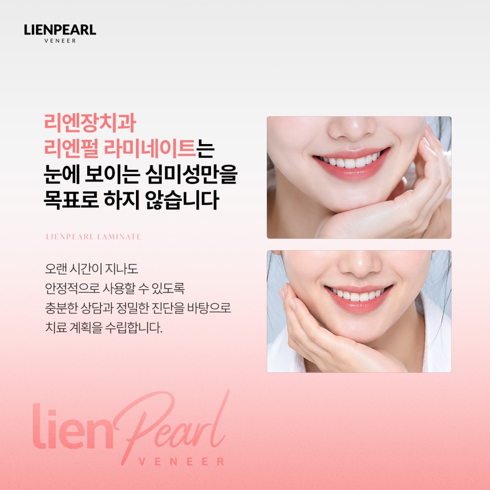 강남역 치아 라미네이트 선택 전 꼭 확인해야 할 기준 관련 이미지 2