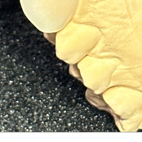 갑자기이빨아플때 원인과 치료 과정 관련 이미지 10