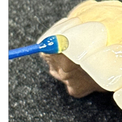 갑자기이빨아플때 원인과 치료 과정 관련 이미지 6