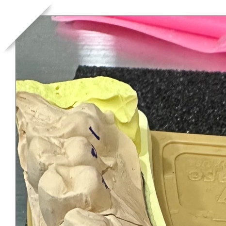 치과보철물 종류별 가격과 특징 관련 이미지 3