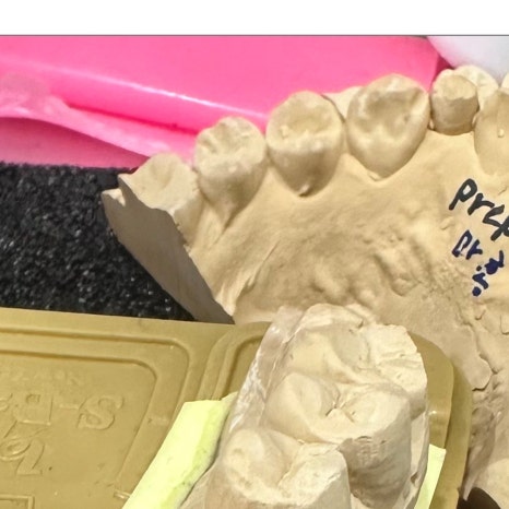 치과보철물 종류별 가격과 특징 관련 이미지 4