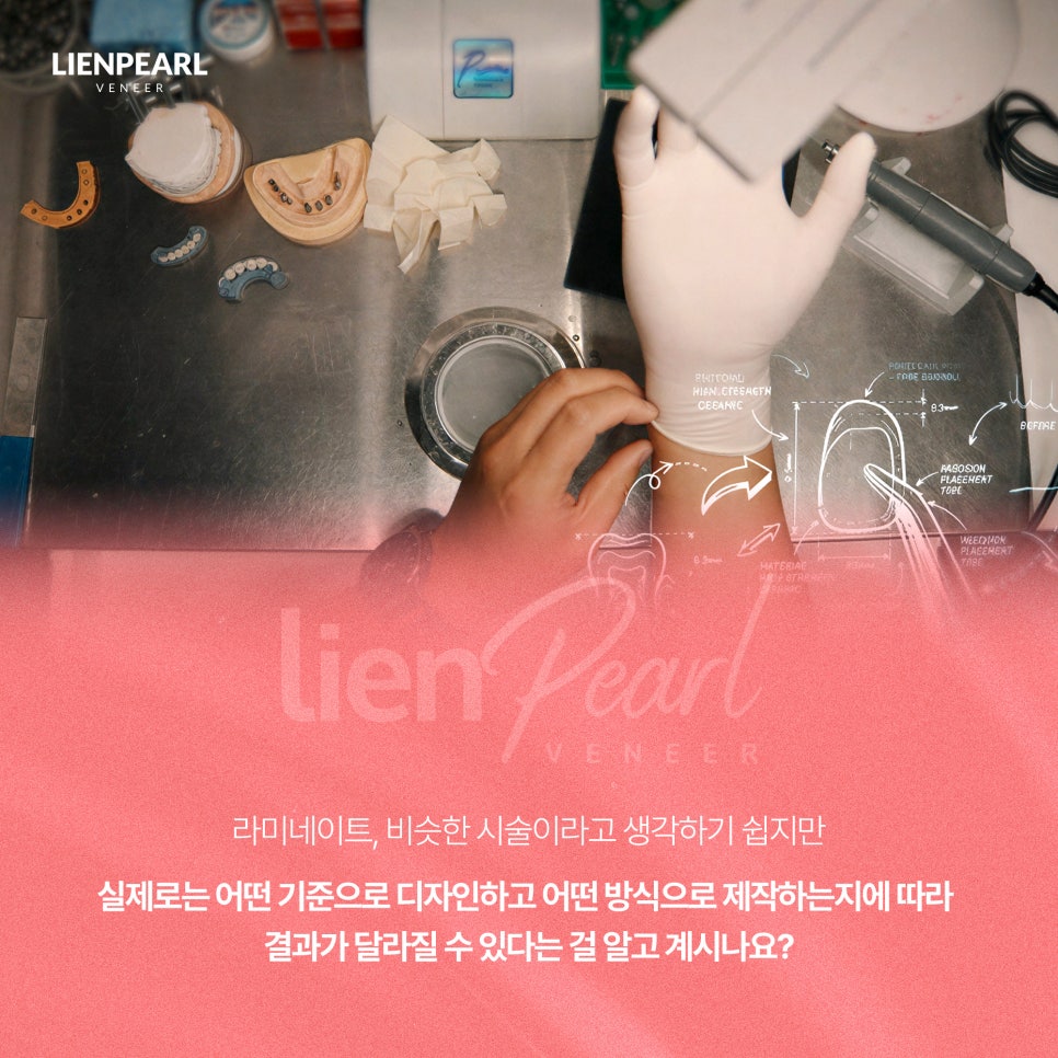 치아 라미네이트 가격이 고민이라면? 상담 전 체크리스트 관련 이미지 2