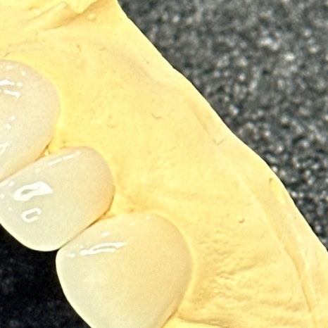 윗니 부분 교정 장단점 정리 관련 이미지 7