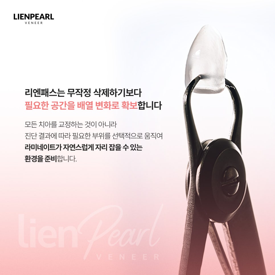 라미네이트 시술 과정은 어떻게 진행될까? 리엔패스로 확인하세요! 관련 이미지 5
