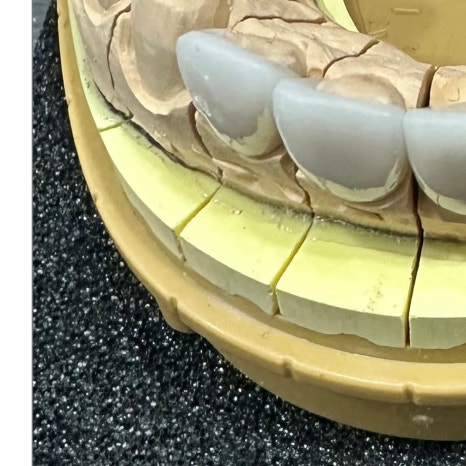 치과보철물 종류별 가격과 특징 관련 이미지 6