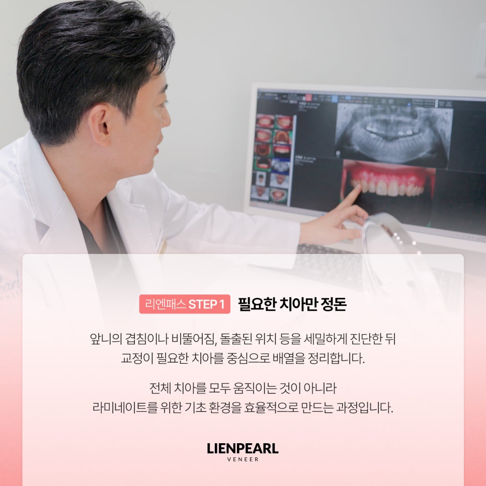 앞니 배열이 고민이라면? 치아교정 라미네이트 리엔패스! 관련 이미지 4