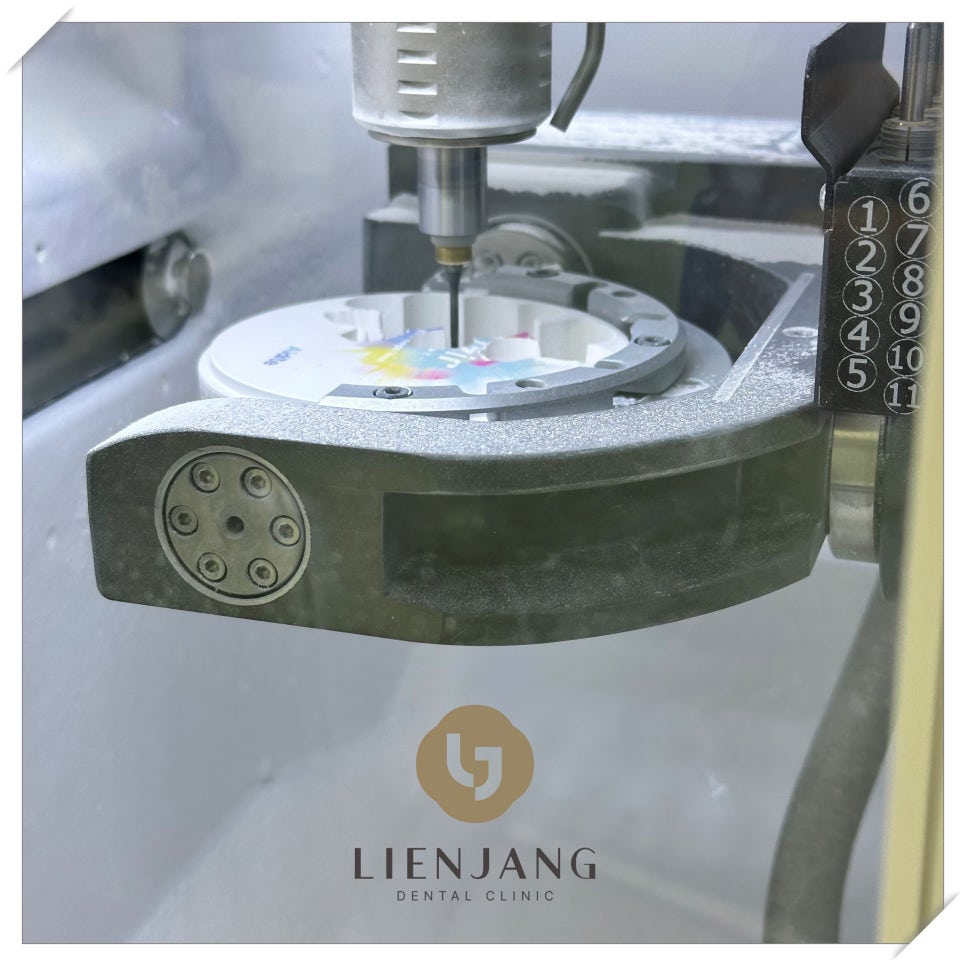 이빨씌우는가격 종류별 차이 관련 이미지 3