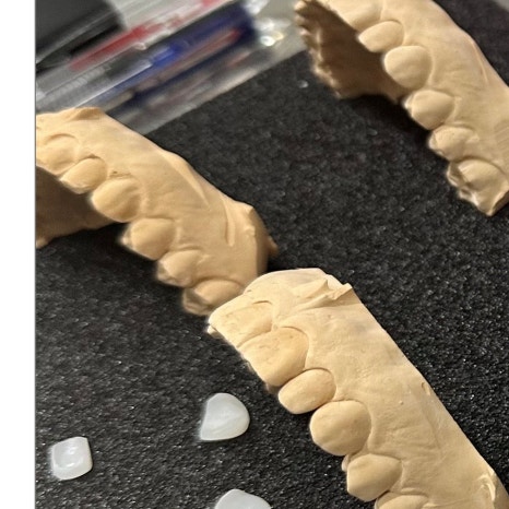 사랑니 수면마취 후기 궁금하다면 관련 이미지 6