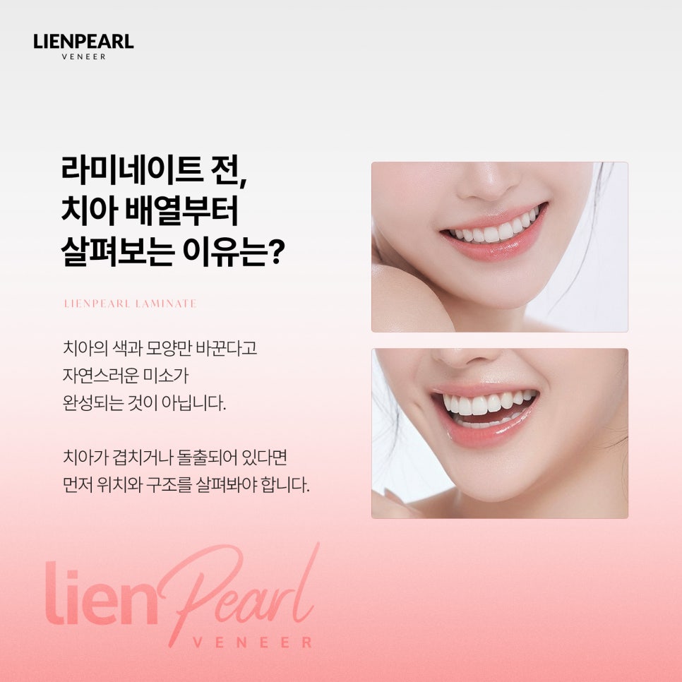 The Dental Laminate Process: Natural Results Begin with Alignment image 2