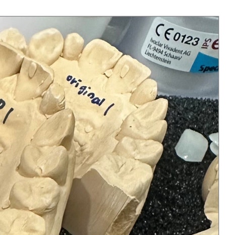 치과보철물 종류별 가격과 특징 관련 이미지 5