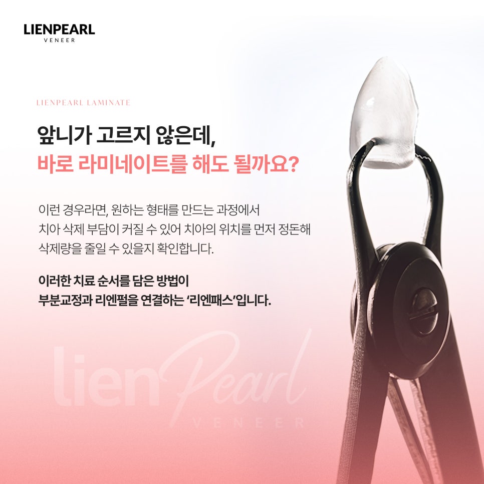 강남구 라미네이트 받기 전에 꼭 확인해야 할 3가지! 관련 이미지 4