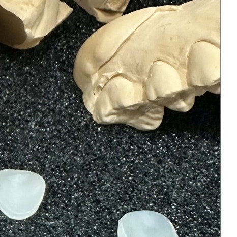 치과보철물 종류별 가격과 특징 관련 이미지 8