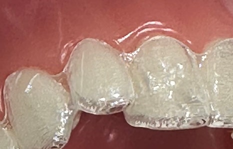 연희임플란트 디지털 네비게이션과 3D 기술로 안전하고 정밀하게 관련 이미지 13