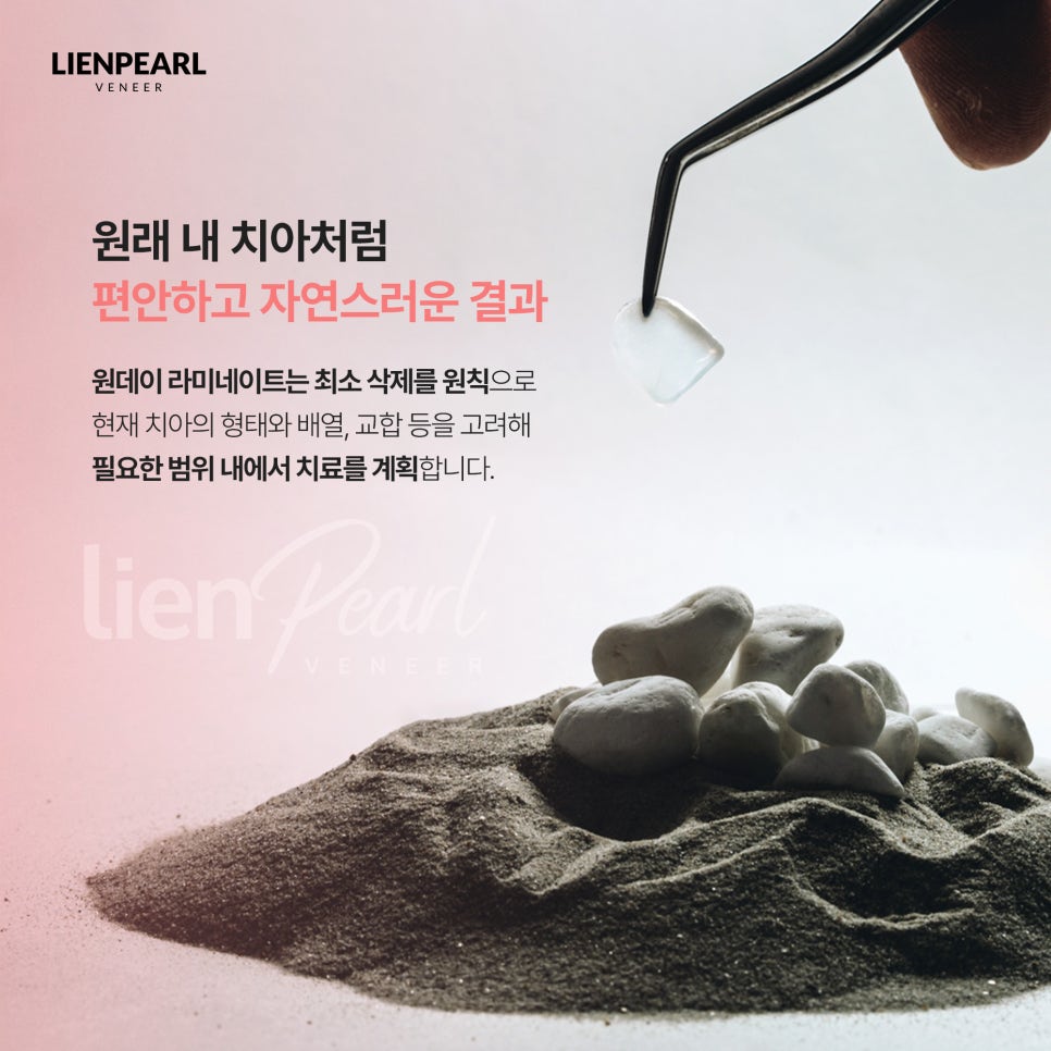 원데이 치아 라미네이트, 나에게 어울리는 자연스러움을 찾는 방법 관련 이미지 5