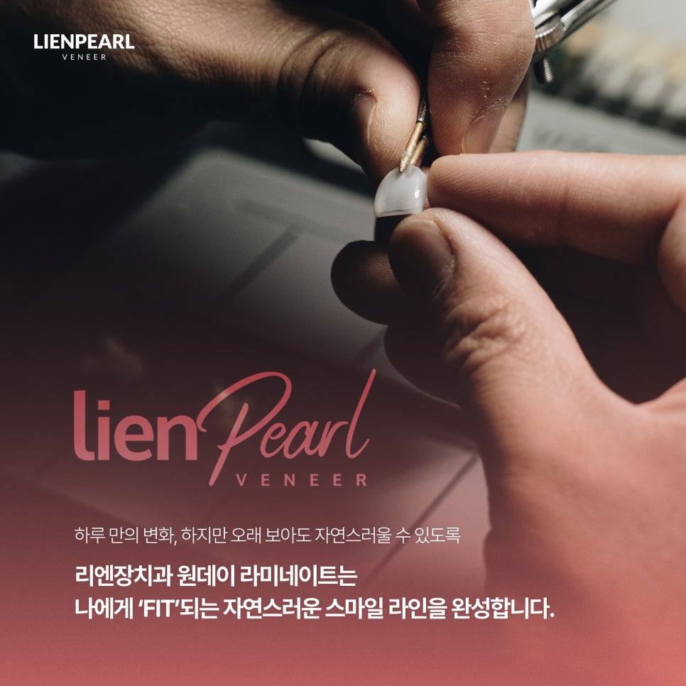 원데이 치아 라미네이트, 나에게 어울리는 자연스러움을 찾는 방법 관련 이미지 7