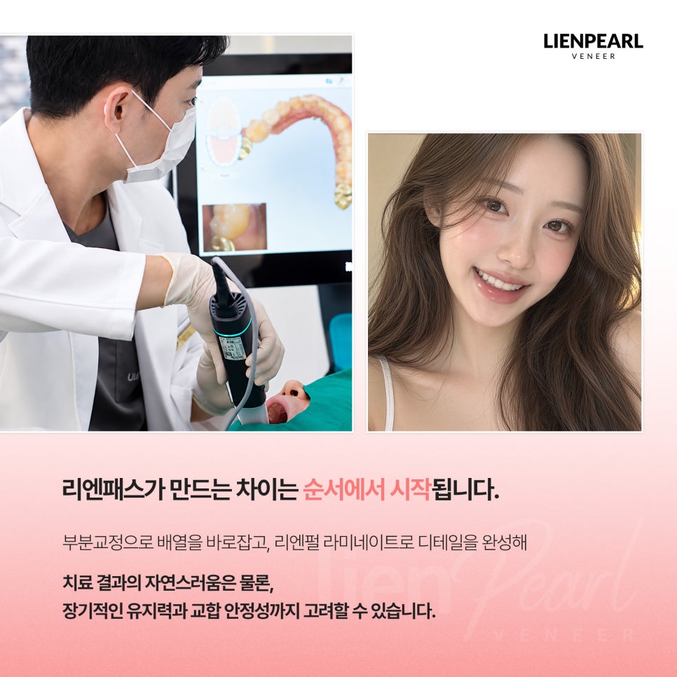 앞니 라미네이트 비용 고민된다면? 함께 확인해야 할 기준 관련 이미지 7