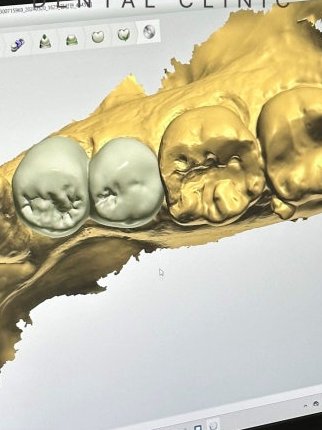 장충동임플란트 주위염 예방하고 건강하게 관련 이미지 17