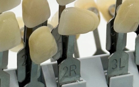 한강로동임플란트 앞니부터 어금니까지 꼼꼼하게 관련 이미지 8