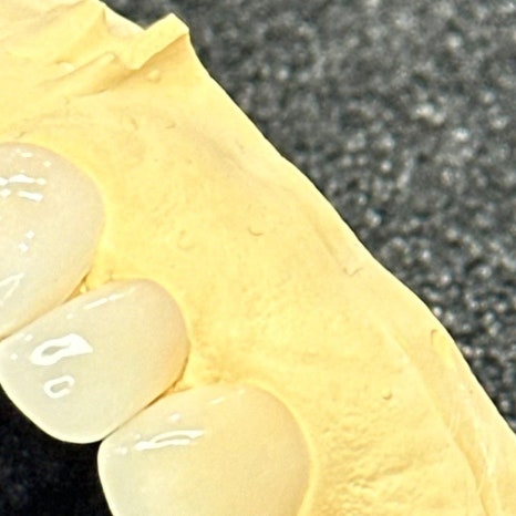 이빨씌우는가격 종류별 차이 관련 이미지 8