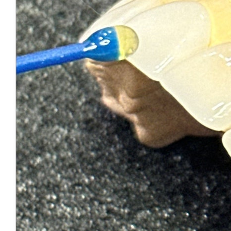 윗니 부분 교정 장단점 정리 관련 이미지 6