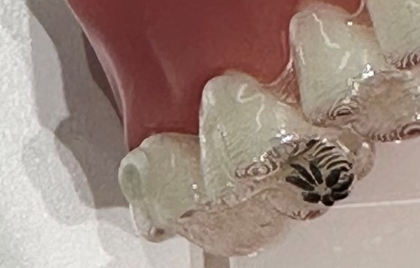 연희임플란트 디지털 네비게이션과 3D 기술로 안전하고 정밀하게 관련 이미지 15