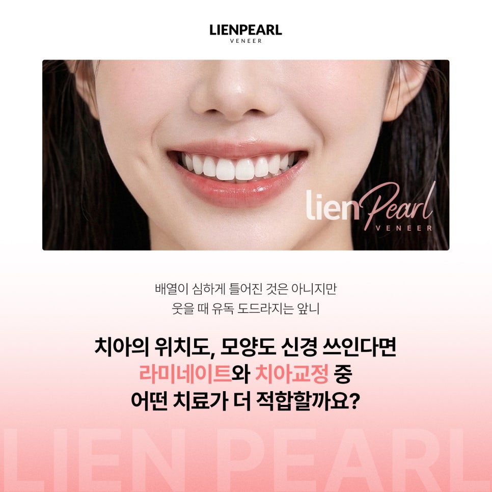 앞니 라미네이트, 치아 모양과 배열에 따라 방법이 달라집니다! 관련 이미지 2