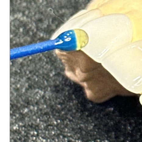 이빨씌우는가격 종류별 차이 관련 이미지 7