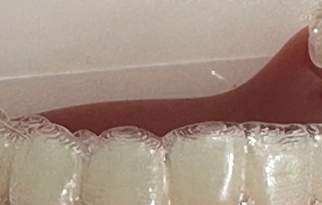 연희임플란트 디지털 네비게이션과 3D 기술로 안전하고 정밀하게 관련 이미지 19