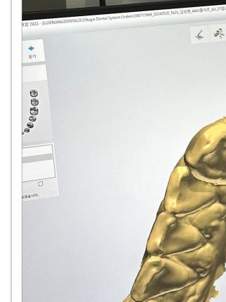 장충동임플란트 주위염 예방하고 건강하게 관련 이미지 16