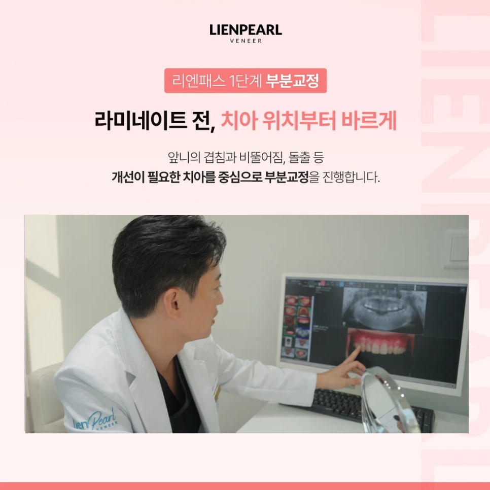라미네이트 기간, 교정이 필요한 경우 얼마나 걸릴까? 관련 이미지 4