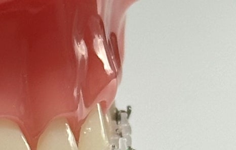 연희임플란트 디지털 네비게이션과 3D 기술로 안전하고 정밀하게 관련 이미지 8