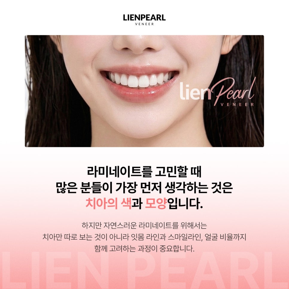 원데이 라미네이트, 하루 만에 자연스러운 결과도 가능할까요? 관련 이미지 2