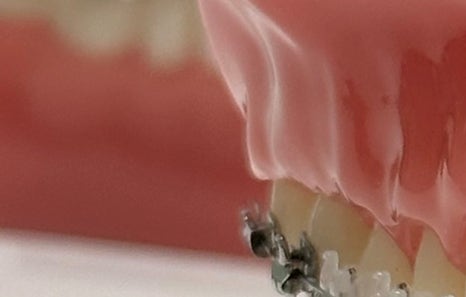 연희임플란트 디지털 네비게이션과 3D 기술로 안전하고 정밀하게 관련 이미지 6