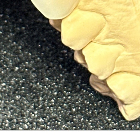 이빨씌우는가격 종류별 차이 관련 이미지 11