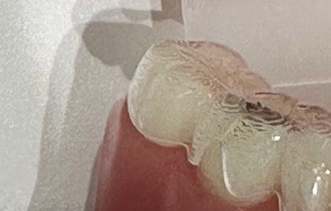 연희임플란트 디지털 네비게이션과 3D 기술로 안전하고 정밀하게 관련 이미지 18