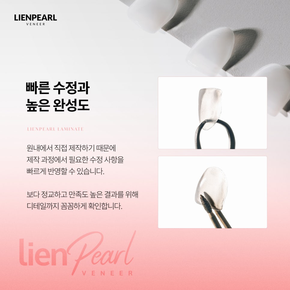 치과 라미네이트, 자연스러움은 디테일에서 시작됩니다 관련 이미지 5