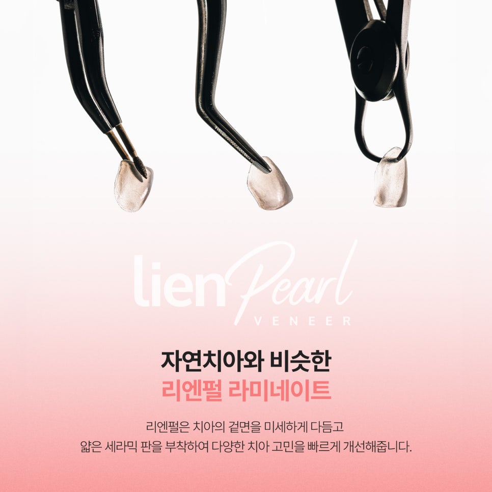 앞니 라미네이트 가격, 제작 기간이 궁금하다면? 관련 이미지 3