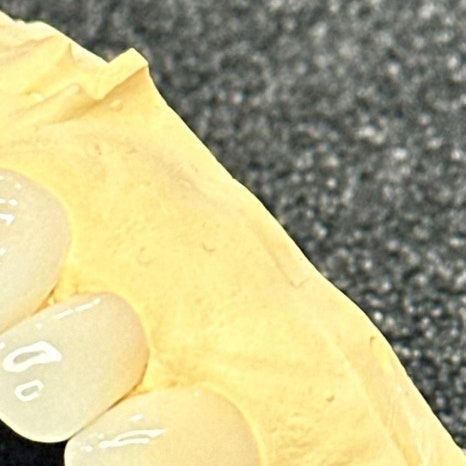 갑자기이빨아플때 원인과 치료 과정 관련 이미지 7