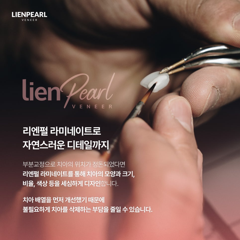 앞니 라미네이트 비용 고민된다면? 함께 확인해야 할 기준 관련 이미지 6