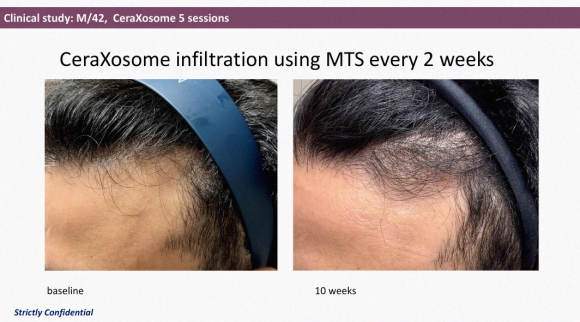 Hair Loss Treatment with Cella Exosome? It Promotes Hair Thickness and Growth Speed. <Real Clinical Results Revealed> image 11