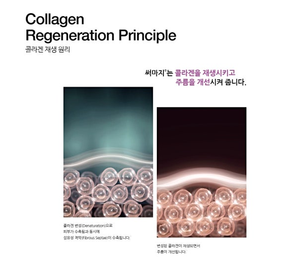 Worried about swelling and pain after Apgujeong Ulthermage? 3 key things to check before the procedure image 5