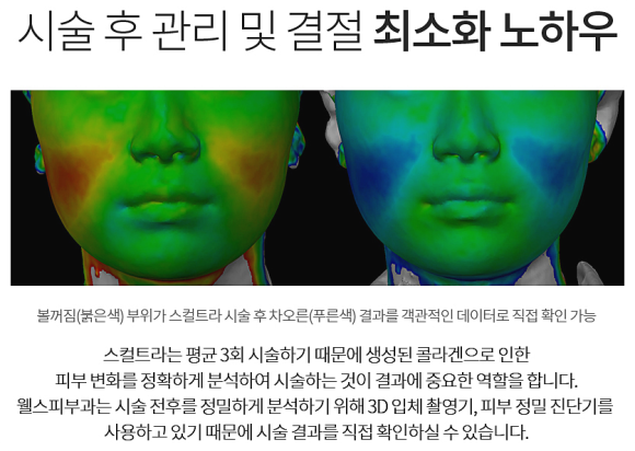 스컬트라 vs 필러 차이, 3D 입체 분석으로 전후를 비교합니다. 관련 이미지 8