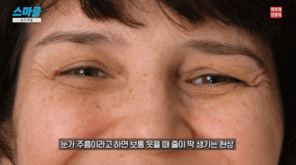 Eye-area wrinkles: the treatment changes depending on the location <feat. Botox, skin boosters, Eye Thermage> image 2