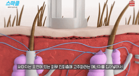 써마지 FLX만 n만 번째, 피부과 전문의가 알려주는 효과 좋은 방법 관련 이미지 4