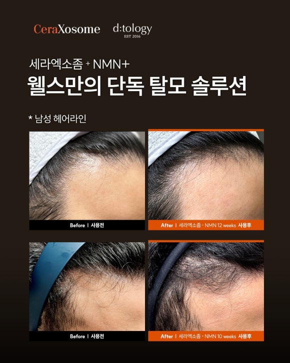 Hair Rejuvenation Therapy: Reviving Hair Vitality with Cera Exosome and Ditology NMN image 4