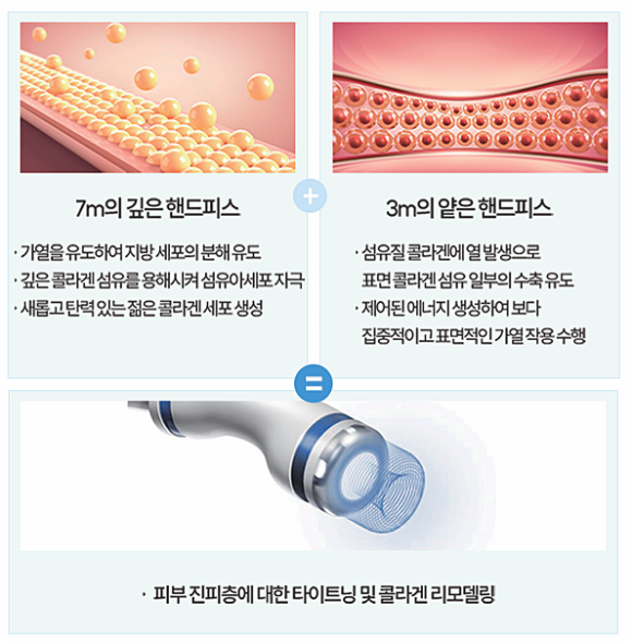 통증과 부기 없는 리프팅? 온다 max 통증과 효과의 차이 관련 이미지 7
